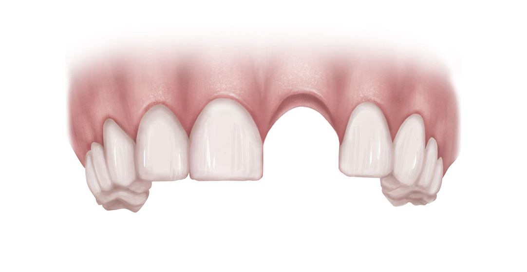 Single missing anterior tooth