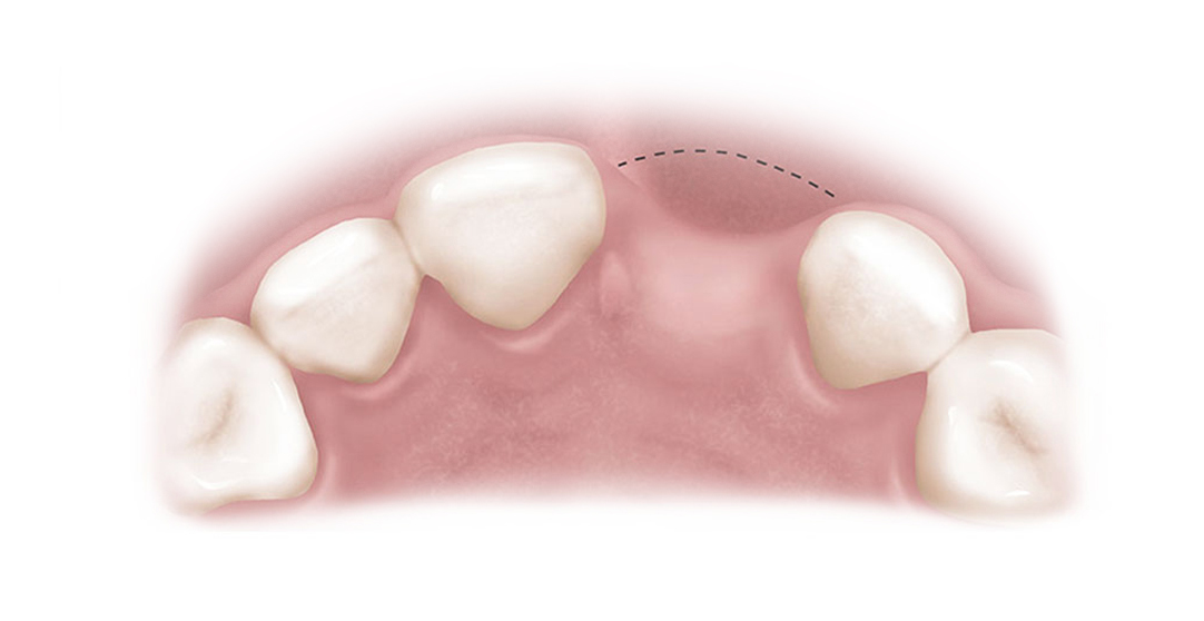 Bone melts away where tooth is
missing, leaving a visible defect