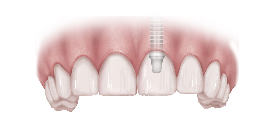 Dental implant crown replaces
the tooth and preserves the bone