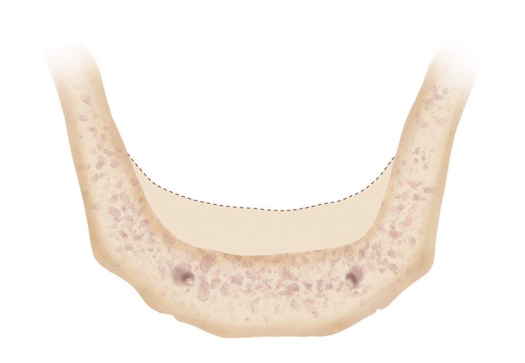 Bone Resorption IDIA The Dental Implant Guide