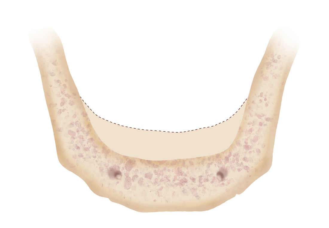 Bone Resorption IDIA The Dental Implant Guide