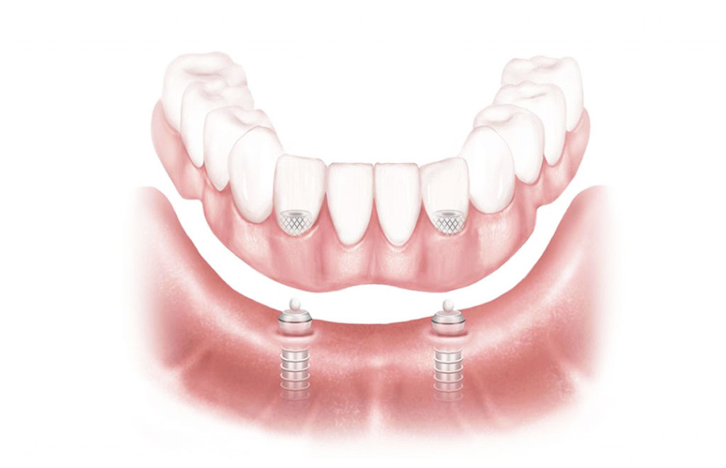 Dental implants preserve bone
and support replacement teeth