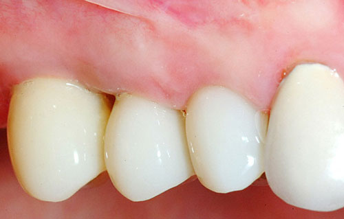 individual crowns on dental implants
