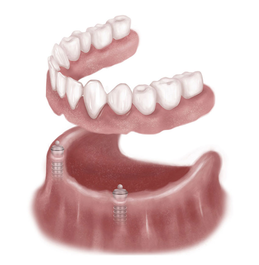 Preferred Method of Stabilizing Dentures IDIA