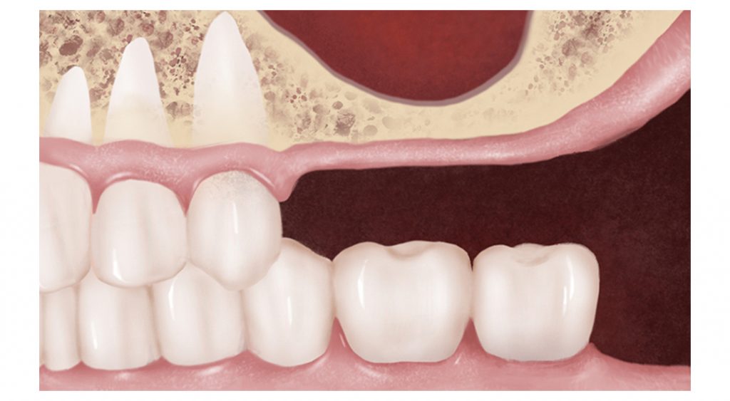 Bone Grafting San Diego Sinus Lift IDIA