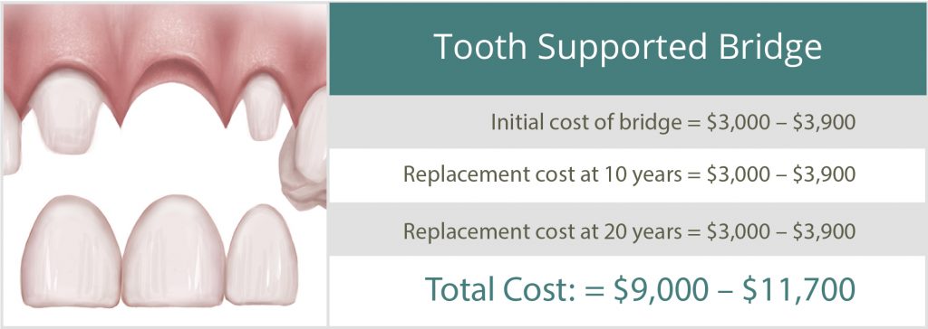 tooth supported bridge costs