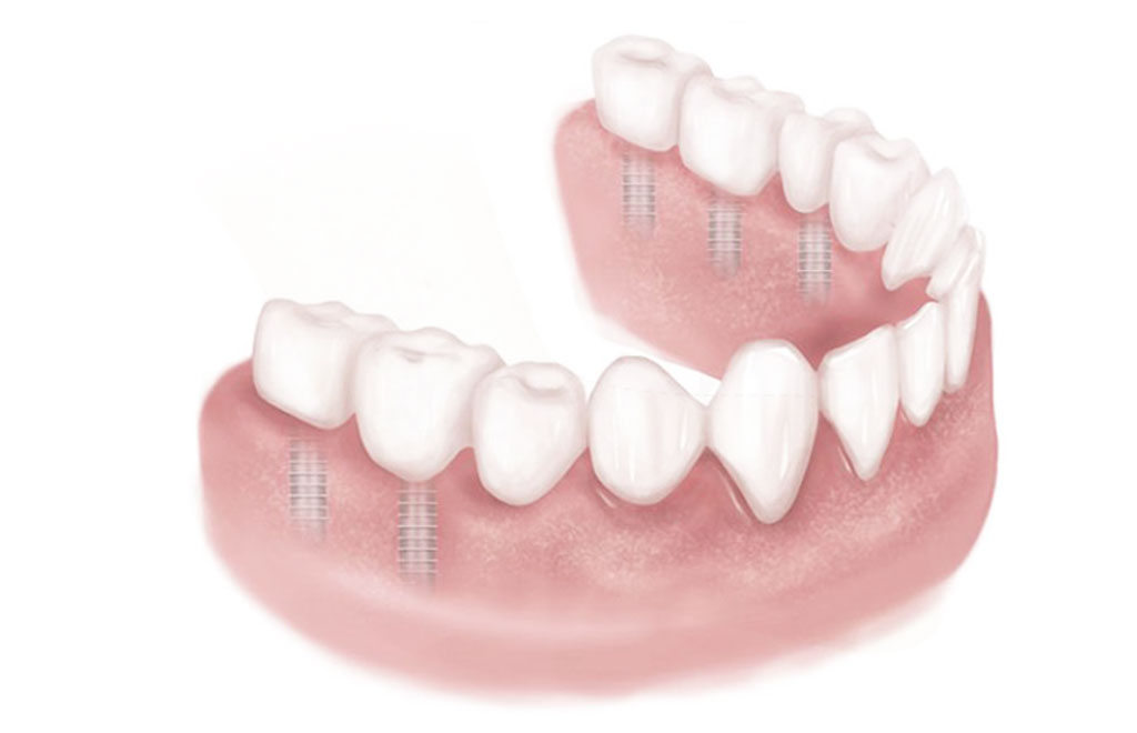 Dental implants and crowns
replace teeth and preserve bone