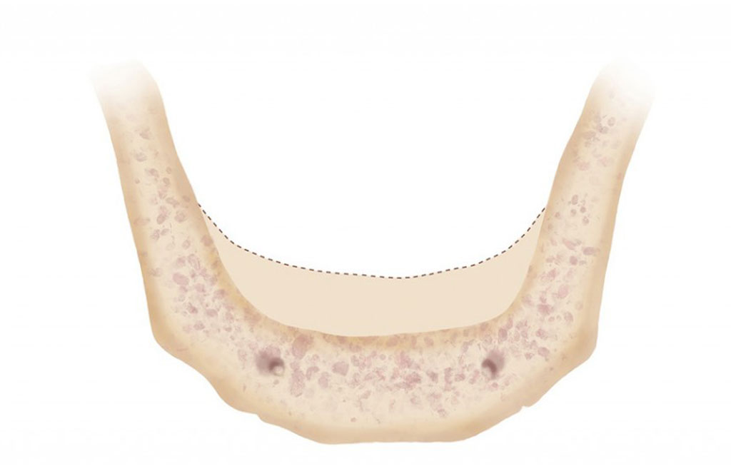 Bone resorption occurs
when all teeth are missing