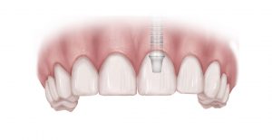 Dental implant crowns preserve bone