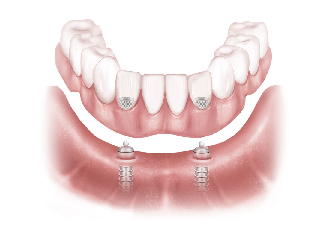 Bone Resorption The Dental Implant Guide