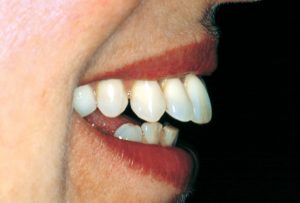 anterior teeth flare out