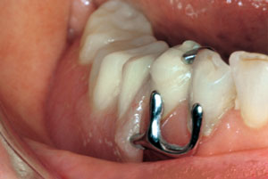 Lower partial denture