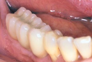 dental implants with crowns