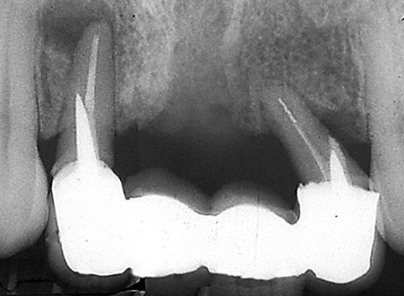 Failed root canal