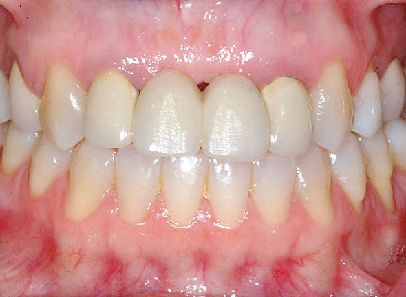bridge is supported by two dental implants