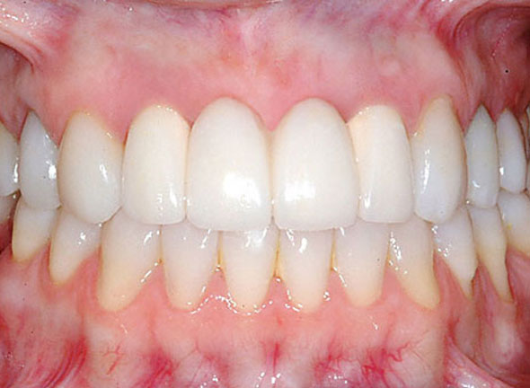 bridge supported by dental implants