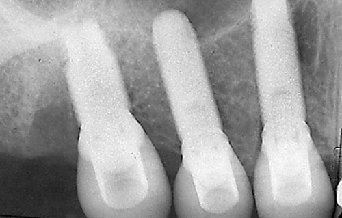 dental implants replaced failed teeth