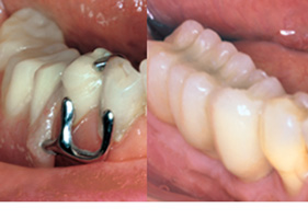 anterior missing tooth