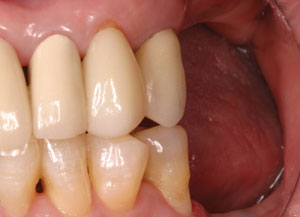 nadji-missing-posterior-teeth