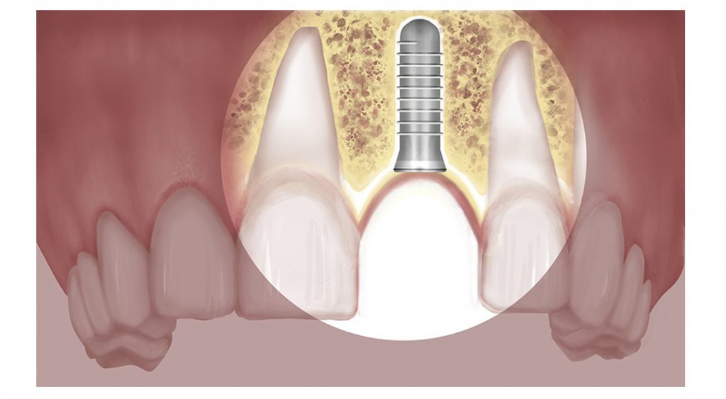 Surgical Extractions The Dental Implant Guide
