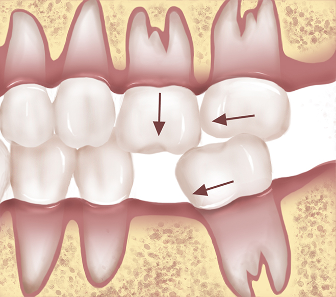 Single Posterior Tooth The Dental Implant Guide
