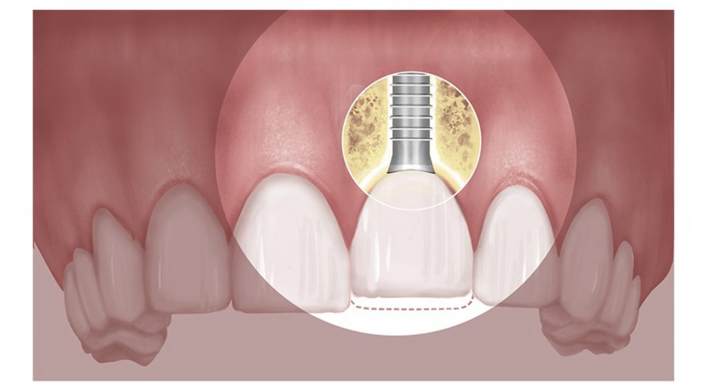 Implant Placement The Dental Implant Guide