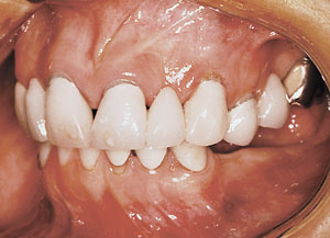 several missing posterior teeth