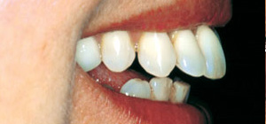 Anterior teeth flare out