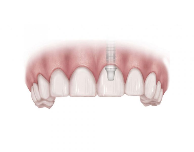 Dental Implants Preserve Adjacent Teeth The Dental Implant Guide